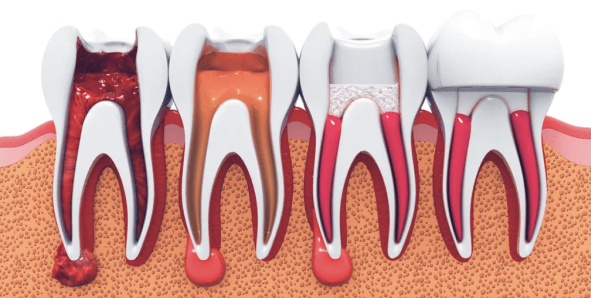 Endodoncia